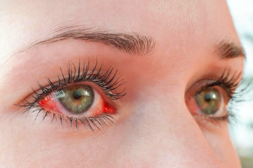 Thyroid eye disease specialist near me